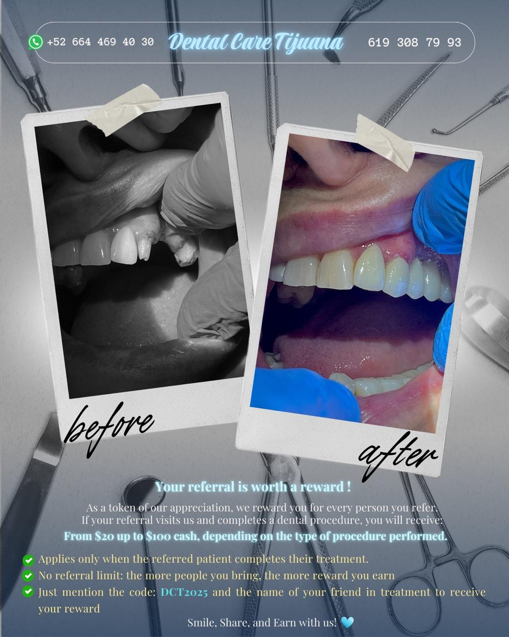 Before and after smile transformation at Dental Care Tijuana