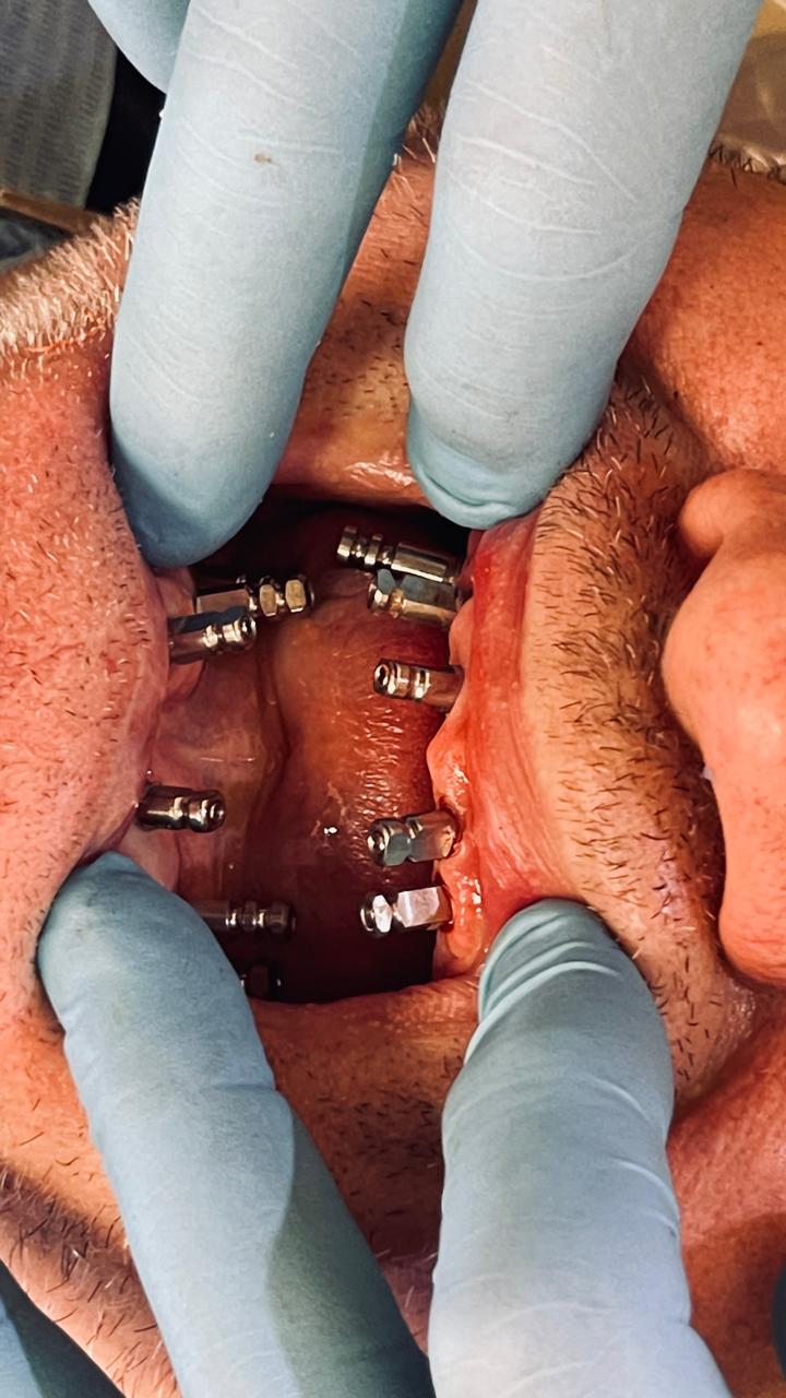 Dental implant restoration detail