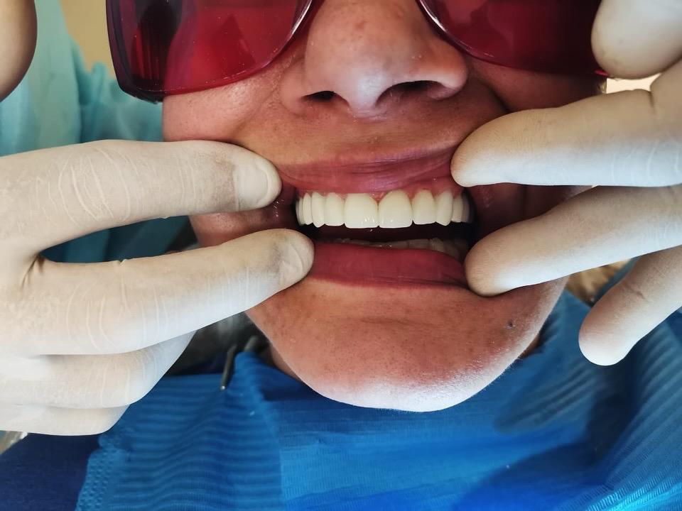 Close-up of patient's teeth after restorative treatment