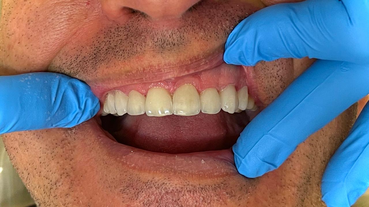 Close-up of patient's teeth showing restorative results