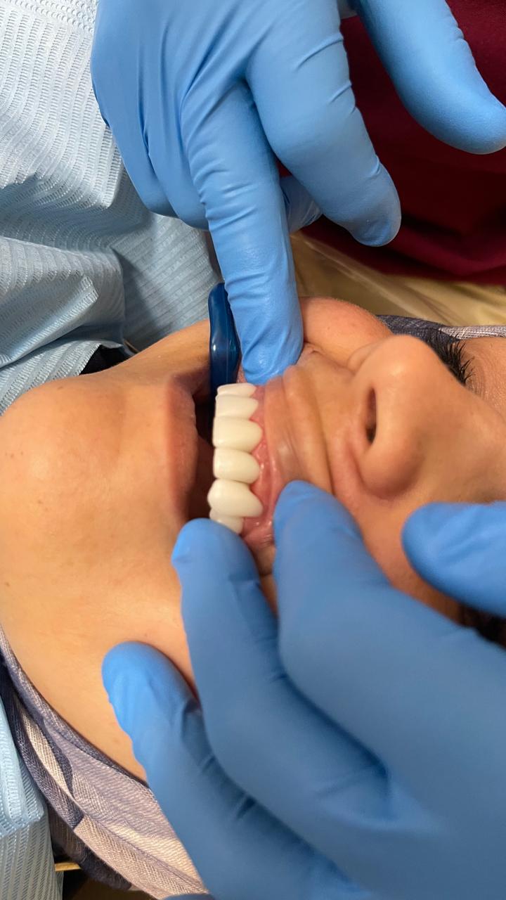 Smile detail after cosmetic and implant dentistry