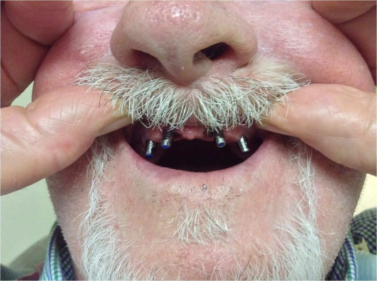 Healing abutments emerging through the gum line after dental implant surgery