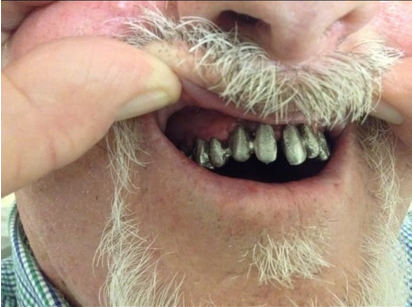 Provisional temporary restorations seated over healed dental implant abutments