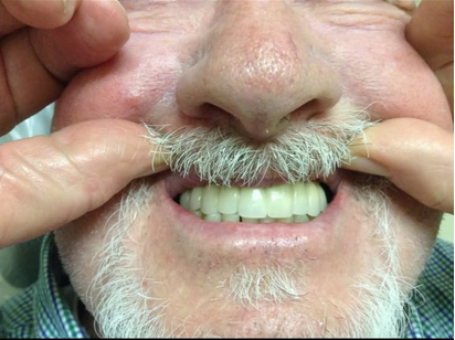 Final porcelain crowns fully placed on dental implants — completed smile restoration